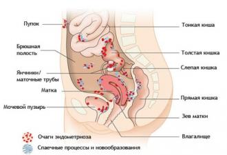 Лечение эндометриоза при планировании беременности