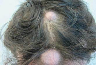 Diagnoza e saktë dhe trajtimi i një çiban në kokë: shembull në foto